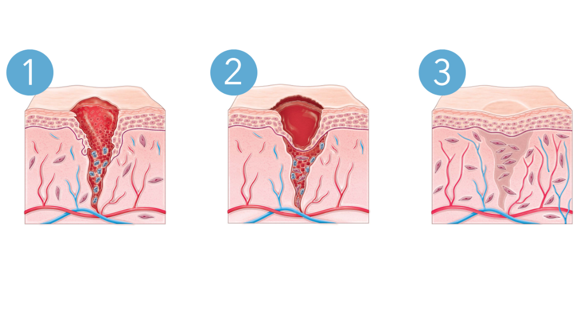 process de cicatrisation, plaie