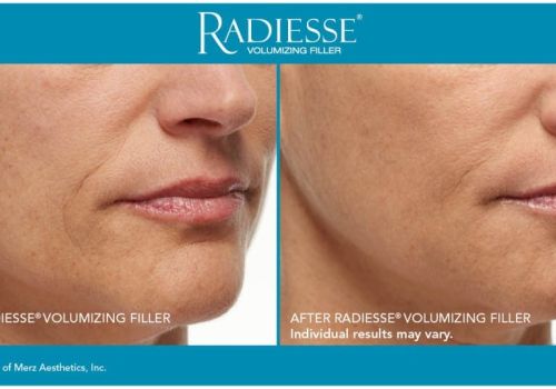 Clinique-du-lac-geneva-cosmetic-center-before-after-injections-radiesse.jpg