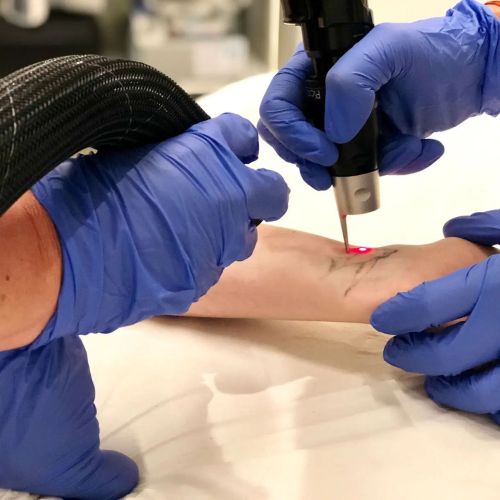 detatouage laser.jpg